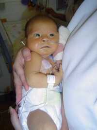 hypoplastic left heart syndrome, congenital heart disease